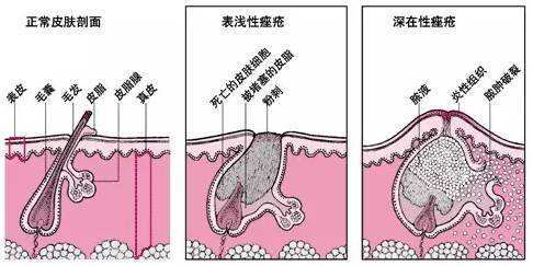 治療痤瘡的最好醫(yī)院,治療痤瘡的最好醫(yī)院，系統(tǒng)化分析與說(shuō)明,科學(xué)解答解釋定義_進(jìn)階版18.44.30