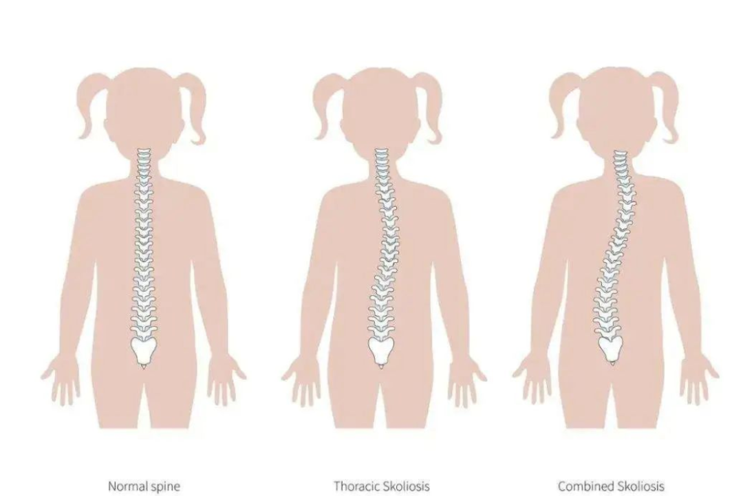 如何自測孩子是否脊柱側(cè)彎